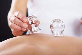 Cupping is just one of the services available at Back to Health in Southbury, Connecticut.