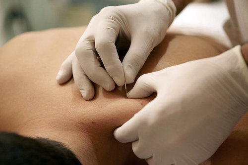 Dry Needling is just one of the treatments available at Back to Health in Southbury, Connecticut.